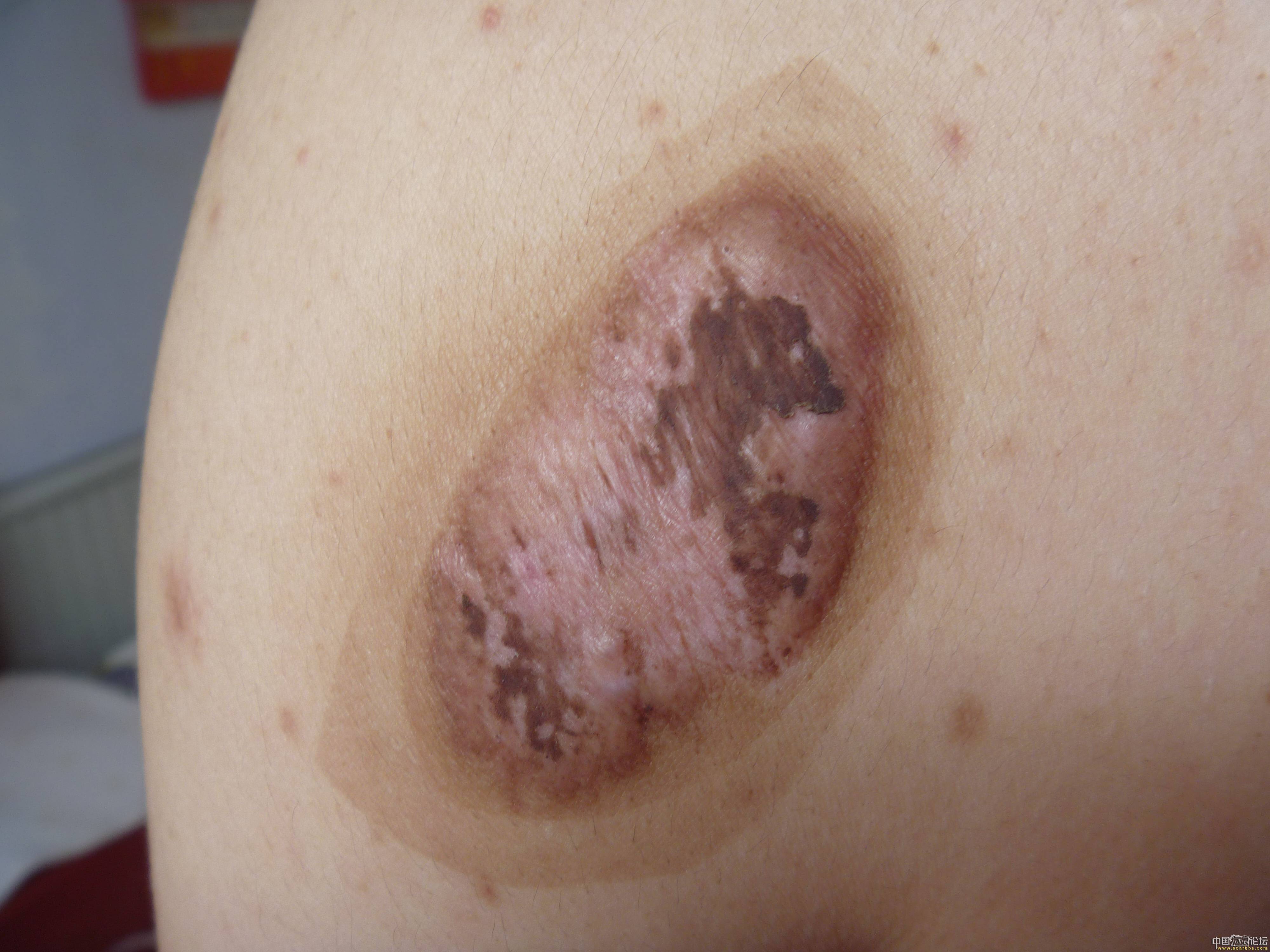 中国疤痕论坛手机版(中国疤痕义诊论坛在线报名)-第5张图片-QuickQ官网